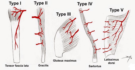 Muscle Flap Classification