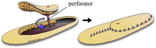 Perforator Flap