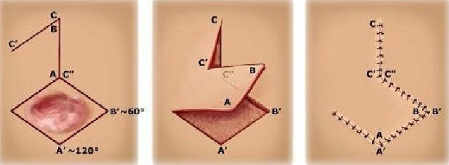 Rhomboid Flap