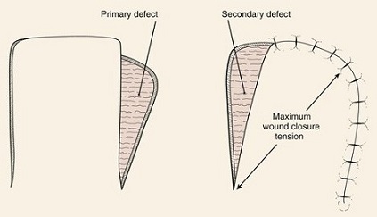 Transposition Flap