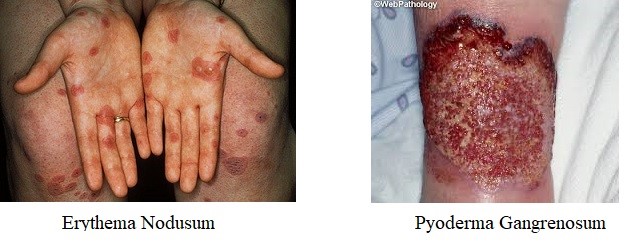 Erythema Nodusom and Pyoderma Gangrenosum