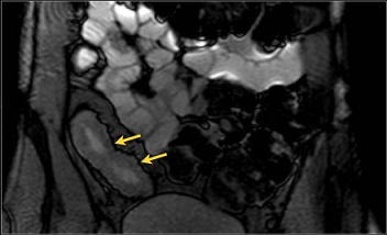 Crohn's Disease MRI