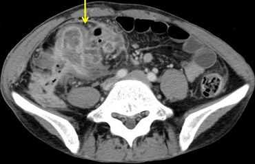 Crohn's Disease Abscess - CT Scan