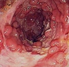 Crohn's Disease - Endoscopy