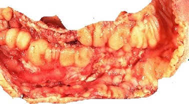 Crohn's Disease - Gross Specimen