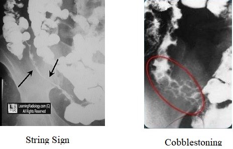 Crohn's Disease - UGI String Sign and Cobblestoning