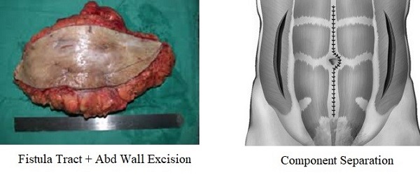 Fistula Tract Excision and Abdominal Wall Reconstruction