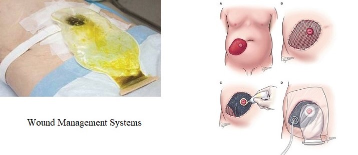 Fistula Wound Management Systems