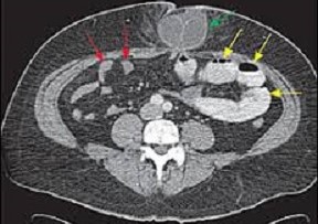 CT Scan:  Incarcerated Umbilical Hernia