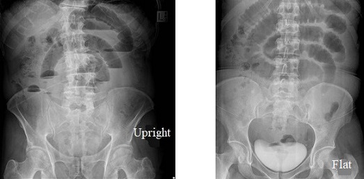 SBO on Upright and Flat Abdominal X-rays