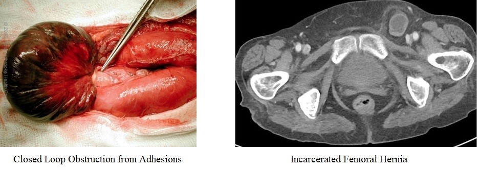 Extrinsic Obstruction:  Adhesions and Incarcerated Femoral Hernia