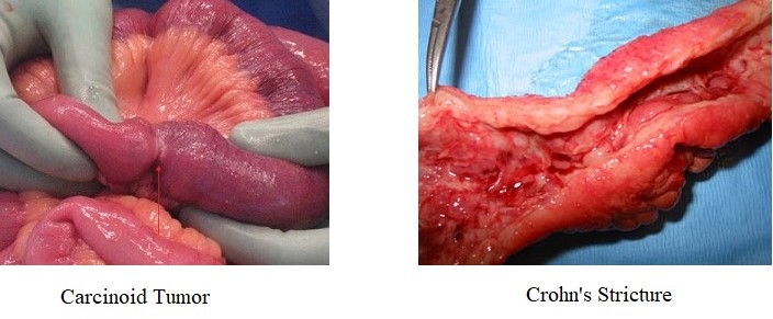 Intramural Obstruction:  Carcinoid Tumor and Crohn's Stricture