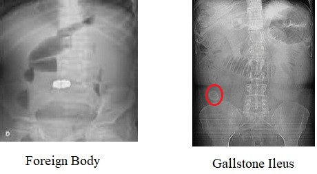 Intraluminal Obstruction:  Foreign body and Gallstone Ileus