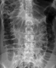 Abdominal X-ray Showing a Diffuse Ileus