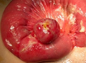 Small Bowel GIST Tumor