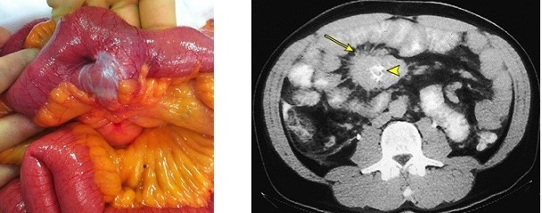 Small Bowel Neuroendocrine Tumor