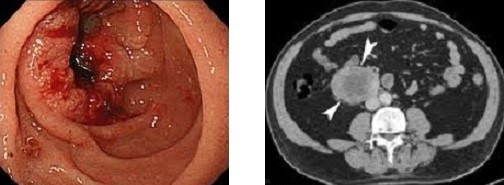 Duodenal Adenocarcinoma