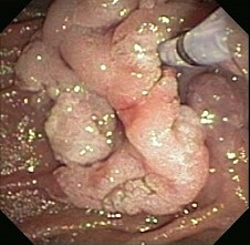 Duodenal Villous Adenoma