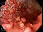 Small Bowel Hamartomas