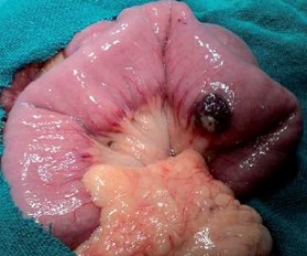 Small Bowel Hemangioma