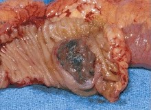 Melanoma Metastatic to the Small Bowel