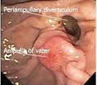 Periampullary Diverticulum