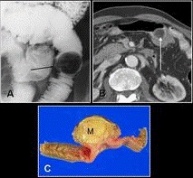 Small Bowel Lipoma