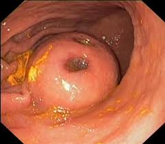 Gastric GIST tumor on EGD