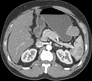 Gastric GIST tumor on CT Scan