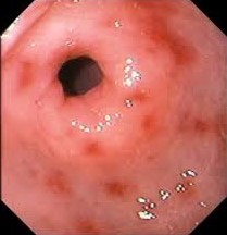 Erosive Gastritis of the Stomach