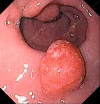 Gastric Polyp