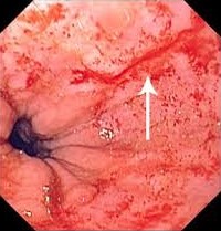 Mallory-Weiss Tear of the Distal Esophagus