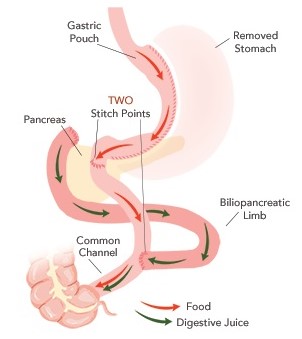 Biliopancreatic Diversion with Duodenal Switch