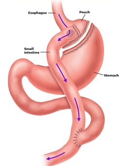 Roux-en-Y Gastric Bypass