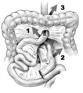 Internal Hernias Associated with Roux-en-Y Gastric Bypass