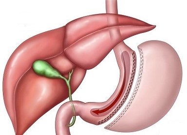 Laparoscopic Sleeve Gastrectomy