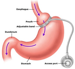 Laparoscopic Adjustable Gastric Band