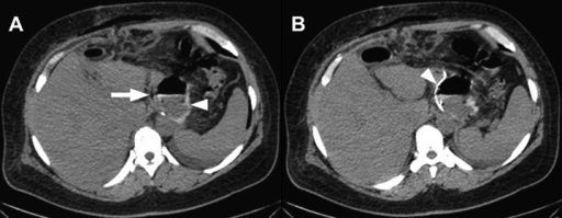 CT of Sleeve Gastrectomy Leak