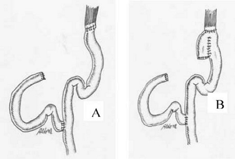 Total Gastrectomy with Possible Reconstructions