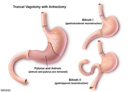 Billroth 1 and Billroth 2 Reconstructions