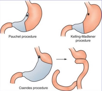 Procedures for Type 4 Gastric Ulcers