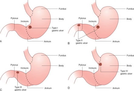 Classification of Gastric Ulcers