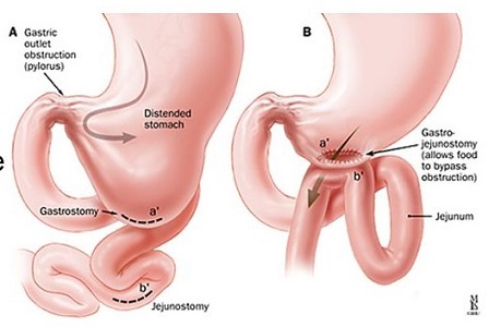 Gastrojejunostomy