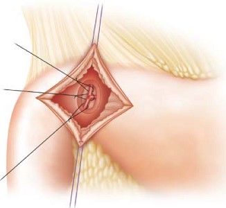 3 Point Ligation of a bleeding Duodenal Ulcer