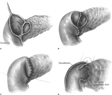 Closure of a Posterior Penetrating Ulcer