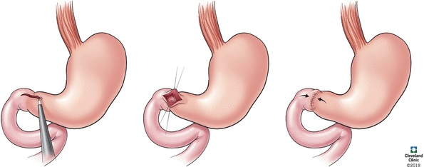 Heineke-Mikulicz Pyloroplasty