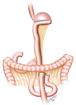 Subtotal Gastrectomy with Roux-en-Y Reconstruction