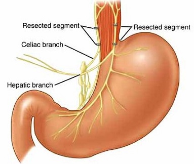 Truncal Vagotomy