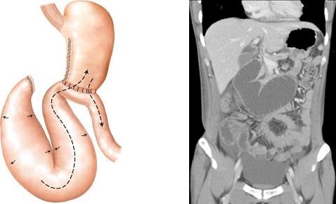 Afferent Limb Obstruction