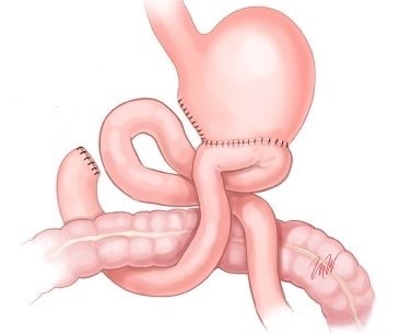 Efferent Limb Obstruction